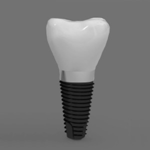 DentalImplant